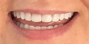 Can a Denture Be Fitted to Receding Gums?