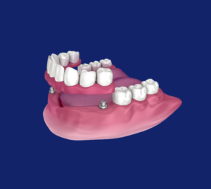 Implant retained dentures