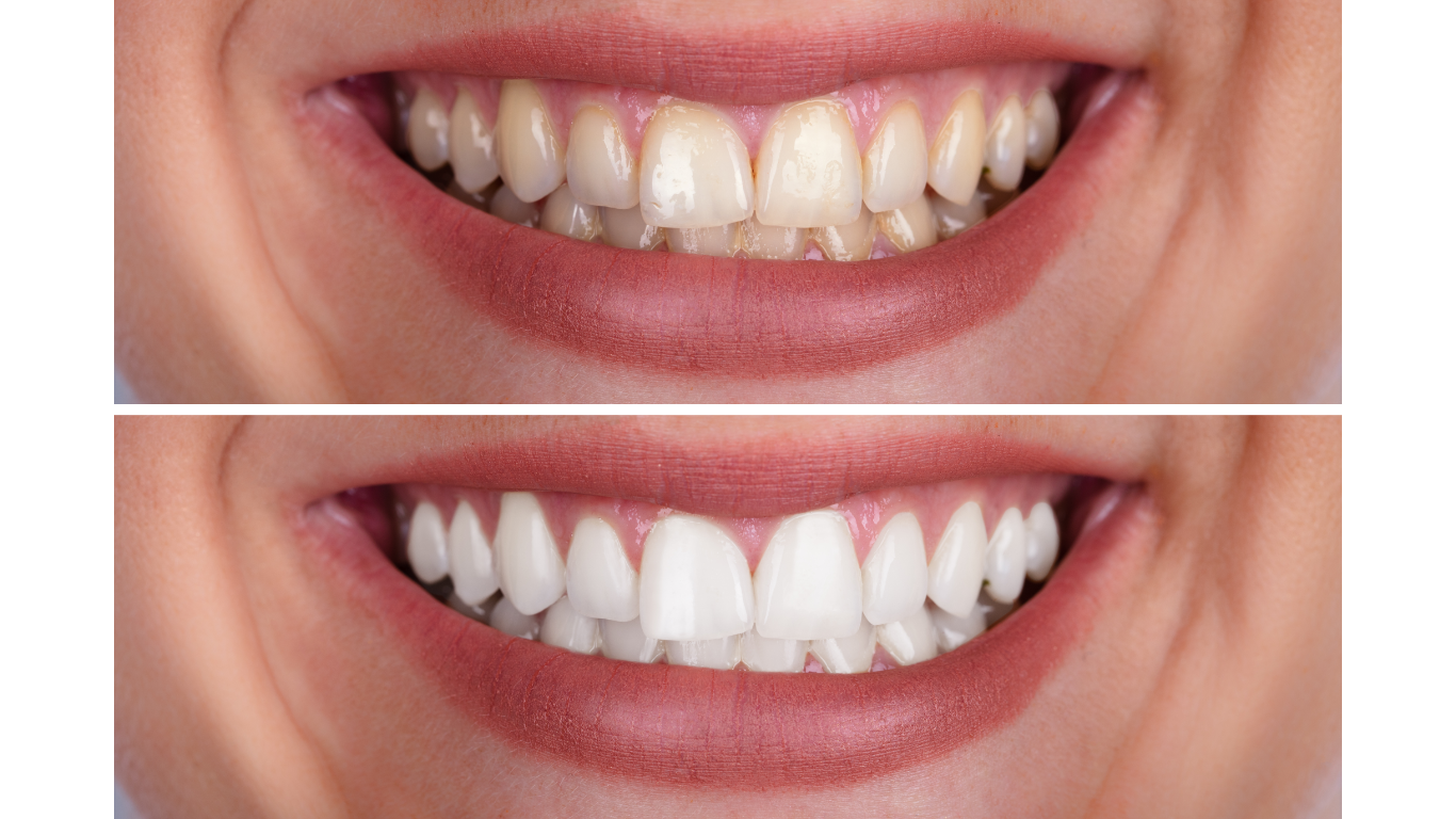 Denturly Teeth whitening service