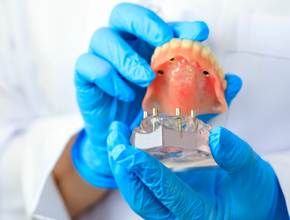Denturly Implant retained Dentures (2)