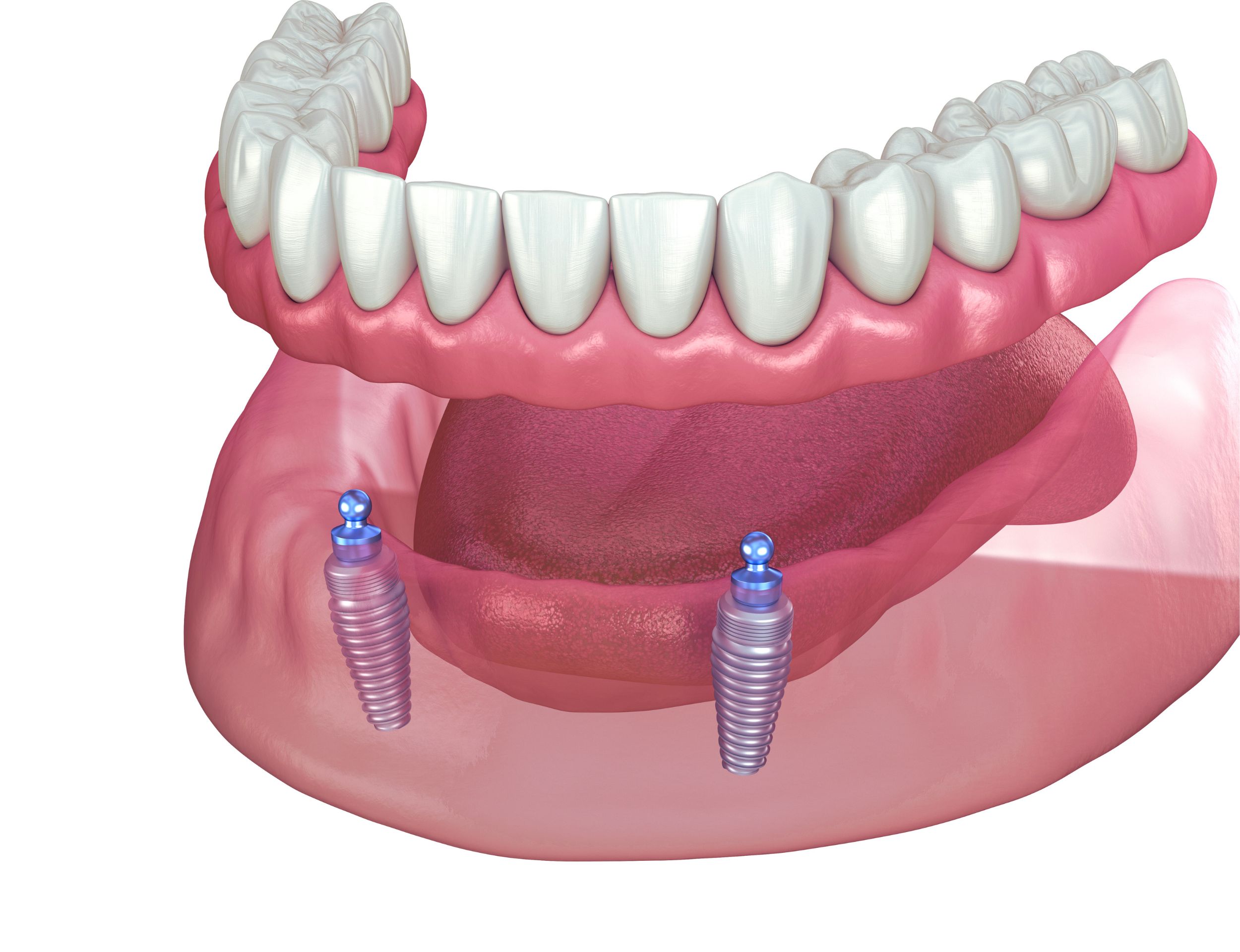 Full Arch Implants