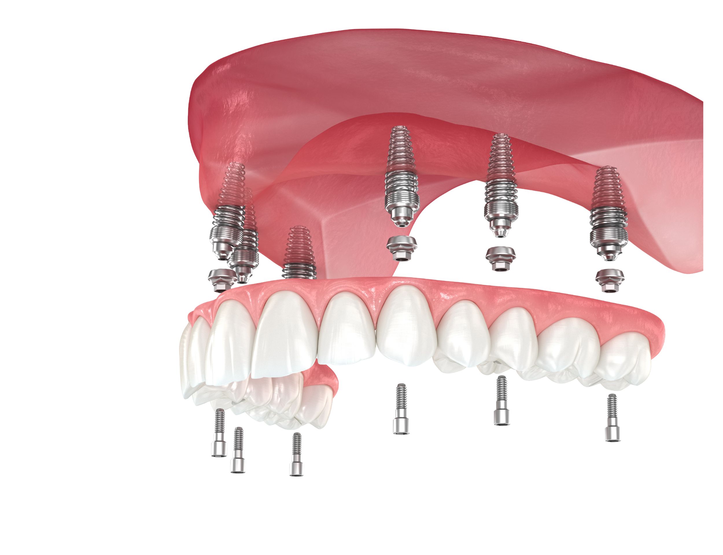 Full mouth fixed Implants