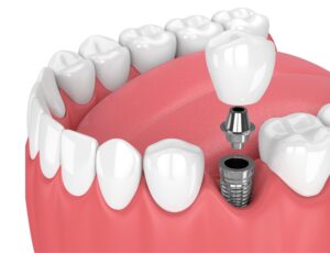 Single Implants