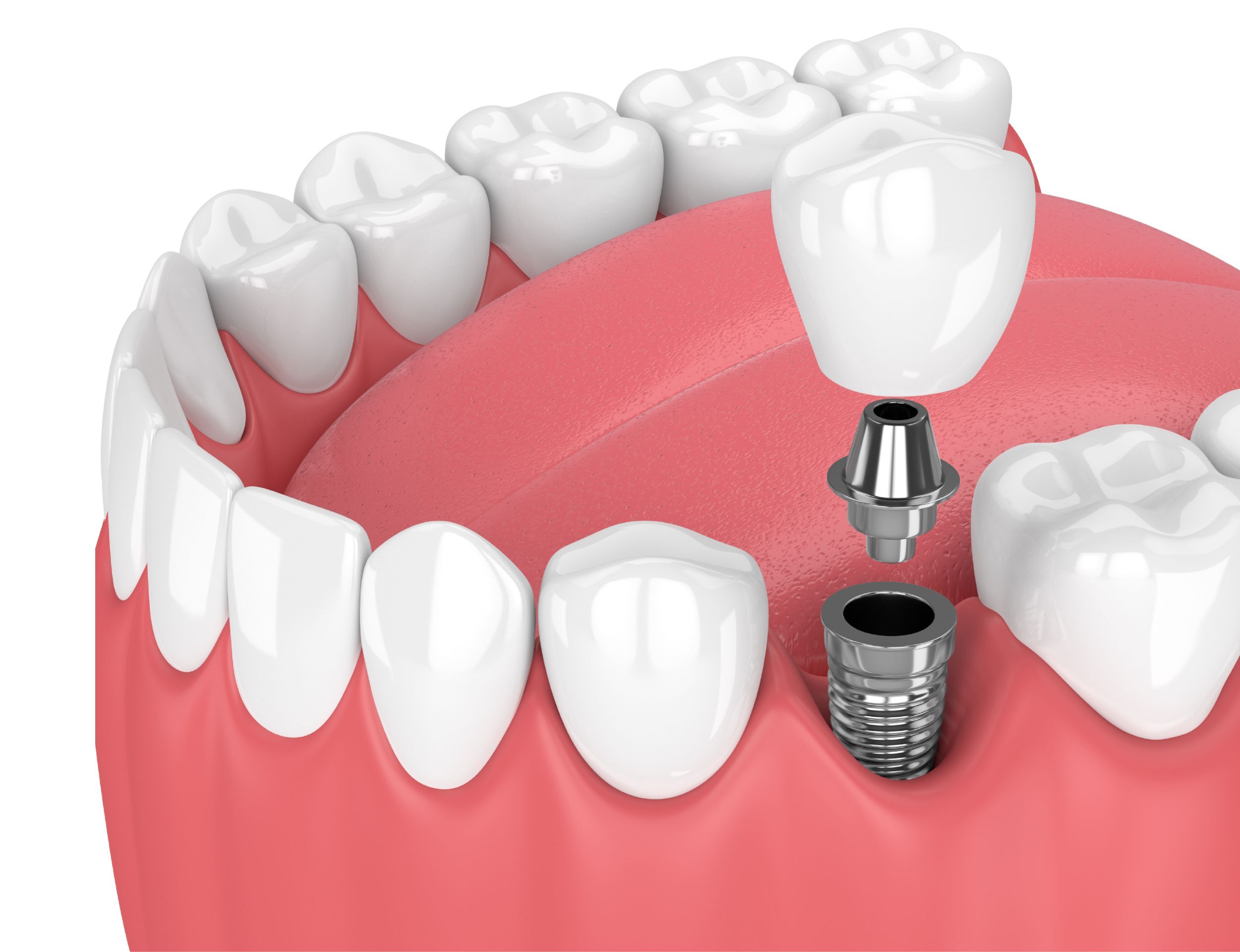Single Implants