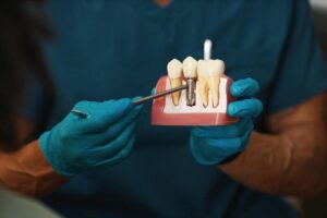 single dental implant