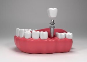 single implants